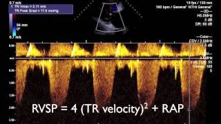 Transthoracic echo (TTE) for beginners