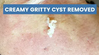 Upper Back Cyst Removed | CONTOUR DERMATOLOGY