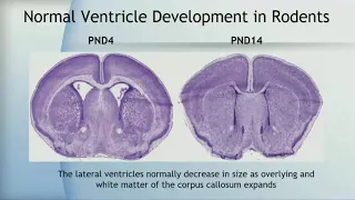 Developmental Neurotoxicity of Ultrafine Particles: Parallels with Neurodevelopmental Disorders