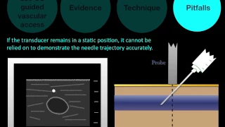 Basic US Course: Ultrasound guided vascular Access