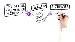 Alzheimer's Disease: The Basics | Being Patient