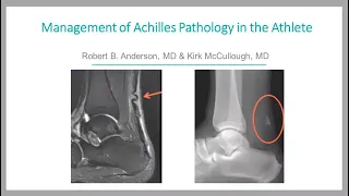 Management of Achilles Pathology in the Athlete