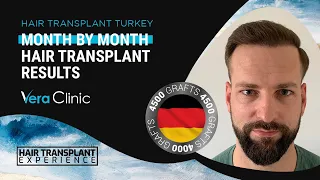 Month by Month #hairtransplant Time Lapse Before After Results | #hairtransplantturkey #4500grafts