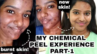 My Chemical Peel Experience(Session1)-Before and After Skin Update!