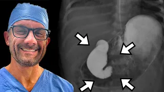 Intestinal Rotation, Malrotation, Volvulus Explained