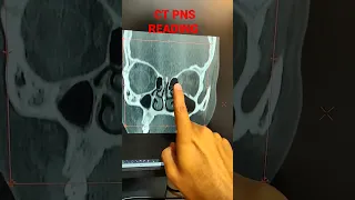 CT PNS #ct #pns #operation #scan