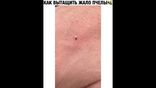 КАК ВЫТАЩИТЬ ЖАЛО ПЧЕЛЫ 🐝#shorts