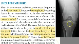 Orthopedics 345 loose bodies knee joint osteophytes OsteoArthritis locking joint