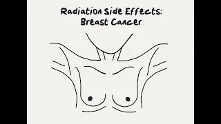 Doctor Explains Radiation Side Effects for Breast Cancer
