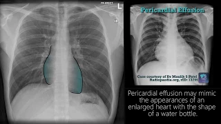 Radiograph Tutorial: Chest X-ray / CXR | Radiology Nation