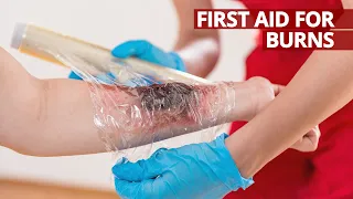 What to do and how to give First Aid for Burns #FirstAid #BeALifesaver