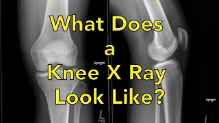 What Does a Knee X Ray Look Like?