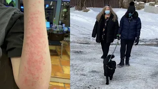 Montreal teen allergic to the cold