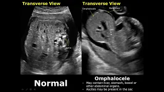 Fetal Bowel Ultrasound Normal Vs Abnormal Image Appearances | Intestine Diseases in Fetus USG