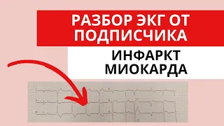 Инфаркт миокарда. Разбор ЭКГ от подписчика. Острый коронарный синдром с подъемом сегмента ST