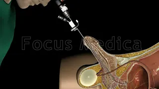 Cystoscopy - Animated Atlas of BPH and OAB