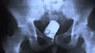 25 Strangest Things Found In X Ray