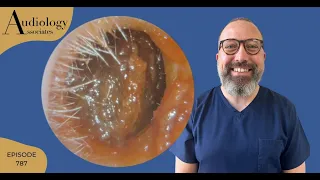 THICK EAR WAX PLUG REMOVAL COMPILATION - EP787