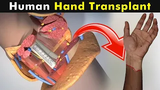 How Does Human Hand Transplant Works? | Human Hand Transplant (Urdu/Hindi)