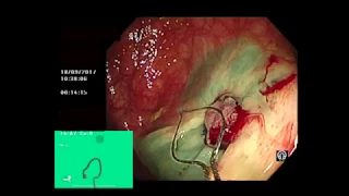 RECURRENT COLONIC POLYPS POST EMR