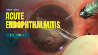 Post-phaco acute endophthalmitis