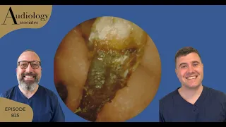 MASSIVE ECZEMA EAR WAX REMOVAL & DIFFICULT DEEP EAR WAX PLUGS - EP825