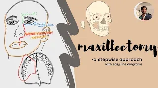 Maxillectomy