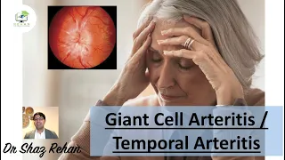 Giant Cell Arteritis (GCA) / Temporal Arteritis - All You Need to Know I Dr Shaz Rehan, 2022