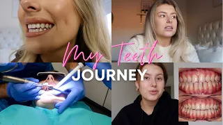 MY TEETH JOURNEY | Braces, Whitening, Composite bonding..I talk about everything!!