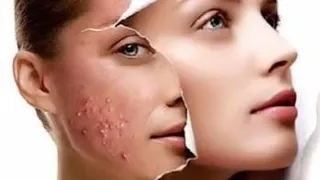 Acne scar removal with Trichloroacetic acid || मुंहासे के दाग (गड्ढे) हटाए