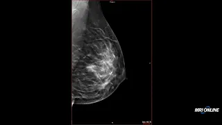 Using Mammography, Tomosynthesis, and Ultrasound in Breast Imaging