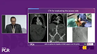 The complexity in treatment of patients in shock - EuroPCR 2024