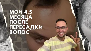 РЕЗУЛЬТАТ ПЕРЕСАДКИ ВОЛОС! Прошло 4,5 месяца