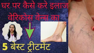 पाँवो की नस फूल जाने  (Varicose Veins) का इलाज  Varicose Veins treatment by Dr Nikita