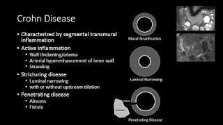 Small Bowel Inflammation