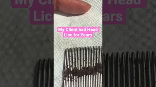 Head Lice for Years 😱 l Lice Removal Service @staceythelouselady #explore #lice #hair