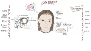 Orbital Cellulitis Springboard