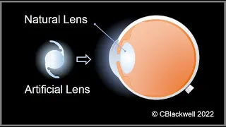 Intraocular Lenses 2: Vision After Surgery