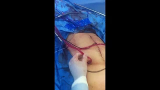 Vídeo Cirúrgico: HIPEC | Dr. Arnaldo Urbano