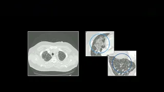 Acute Pulmonary Presentations Part 1 | Free Radiology CME