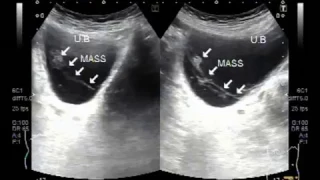 Ultrasound Video showing an unusual shaped Growth in the Urinary Bladder. Part one