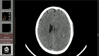 Subacute Infarction and Increased Vasogenic Edema