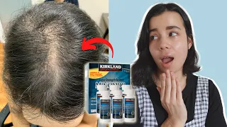 Can Women Use Minoxidil (Rogaine) 2022 | WATCH THIS before starting Minoxidil