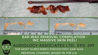 EAR WAX REMOVAL COMPILATION - INC 4.5CM/1.75 IN SKIN PEEL - EP 297