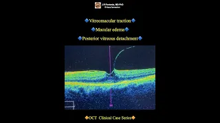 Vitreomacular traction. Macular edema. Posterior vitreous detachment.