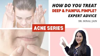 How do you treat Deep & Painful Pimple? | Treat Acne | Skinsquare by Dr Sonal jain