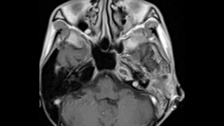 Petrous Apex Abscess