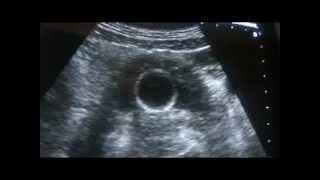 ultrasound how to scan PROSTATE 1 0F 3