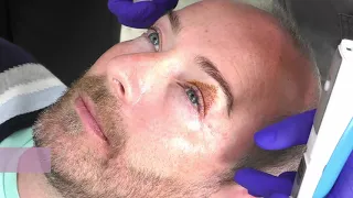 Fashion designer Scott Henshall | Non-surgical eyelift at Queensway Skin Clinic