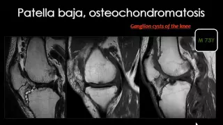 Imaging of Knee part 2   Dr Mamdouh Mahfouz